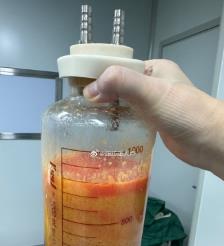 正定水动力吸脂手术要做多久？